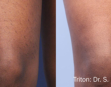 laser hair removal austin dark skin